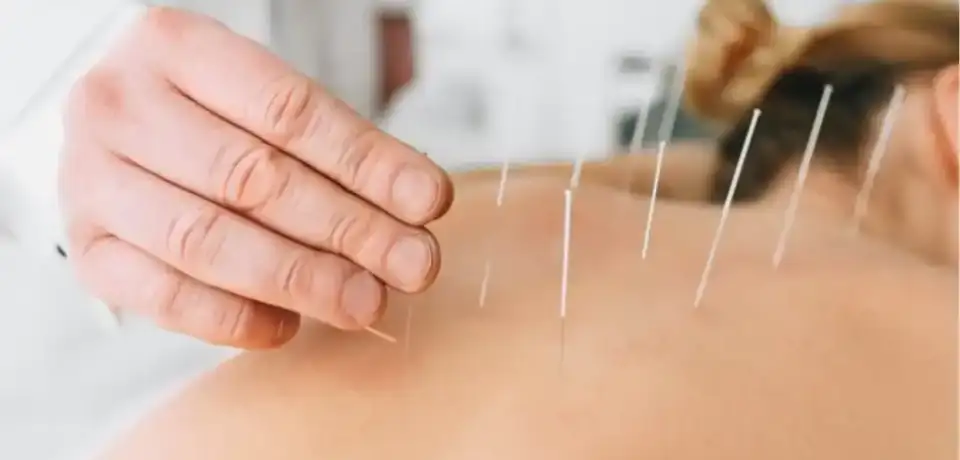 Dry-Needling-1024x722-1